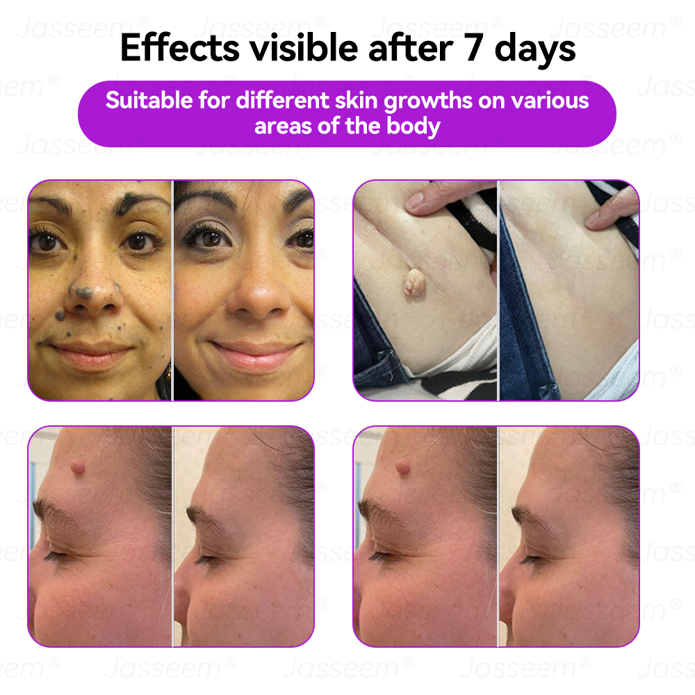 𝐉𝐚𝐬𝐬𝐞𝐞𝐦® 🔥𝐀𝐝𝐯𝐚𝐧𝐜𝐞𝐝 𝐍𝐨𝐧-𝐢𝐧𝐯𝐚𝐬𝐢𝐯𝐞 𝐒𝐤𝐢𝐧 𝐑𝐞𝐩𝐚𝐢𝐫 𝐂𝐎₂ 𝐋𝐚𝐬𝐞𝐫 𝐏𝐞𝐧(Gently gets rid of warts, moles, age spots, and skin tags – no pain, no fuss!)