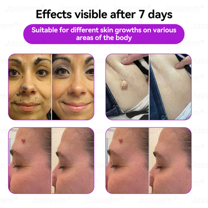 𝐉𝐚𝐬𝐬𝐞𝐞𝐦® 🔥𝐀𝐝𝐯𝐚𝐧𝐜𝐞𝐝 𝐍𝐨𝐧-𝐢𝐧𝐯𝐚𝐬𝐢𝐯𝐞 𝐒𝐤𝐢𝐧 𝐑𝐞𝐩𝐚𝐢𝐫 𝐂𝐎₂ 𝐋𝐚𝐬𝐞𝐫 𝐏𝐞𝐧(Gently gets rid of warts, moles, age spots, and skin tags – no pain, no fuss!)