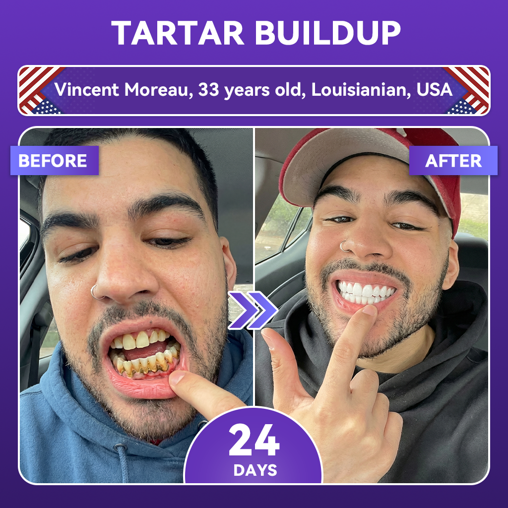 𝐺𝑙𝑖𝑚𝑚𝑒𝑟𝑙𝑦® 𝐴𝑑𝑣𝑎𝑛𝑐𝑒𝑑 𝑃𝑢𝑟𝑝𝑙𝑒 𝑊ℎ𝑖𝑡𝑒𝑛𝑖𝑛𝑔 𝑆𝑡𝑟𝑖𝑝𝑠