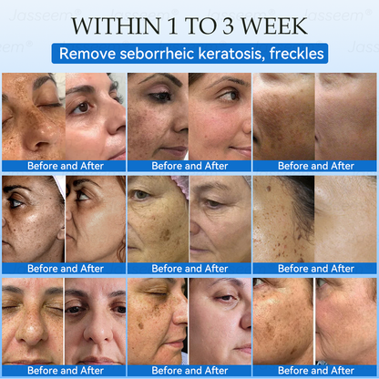 𝐉𝐚𝐬𝐬𝐞𝐞𝐦® ✅✅𝐍𝐨𝐧-𝐈𝐧𝐯𝐚𝐬𝐢𝐯𝐞 𝐌𝐨𝐥𝐞 & 𝐖𝐚𝐫𝐭 𝐋𝐚𝐬𝐞𝐫 𝐑𝐞𝐦𝐨𝐯𝐚𝐥 𝐏𝐞𝐧 (𝐩𝐚𝐢𝐧𝐥𝐞𝐬𝐬 𝐫𝐞𝐦𝐨𝐯𝐚𝐥 𝐨𝐟 𝐰𝐚𝐫𝐭𝐬, 𝐦𝐨𝐥𝐞𝐬, 𝐚𝐠𝐞 𝐬𝐩𝐨𝐭𝐬, 𝐚𝐧𝐝 𝐬𝐤𝐢𝐧 𝐭𝐚𝐠𝐬)