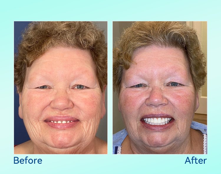 🔥 Only 4 boxes left! Enjoy an extra 50% off! Recommended by dentists, 𝐁𝐢𝐤𝐞𝐧𝐝𝐚® ensures your oral health so you can enjoy meals safely and naturally. Don’t miss out—act now or wait until next year! Enhance your oral health today!