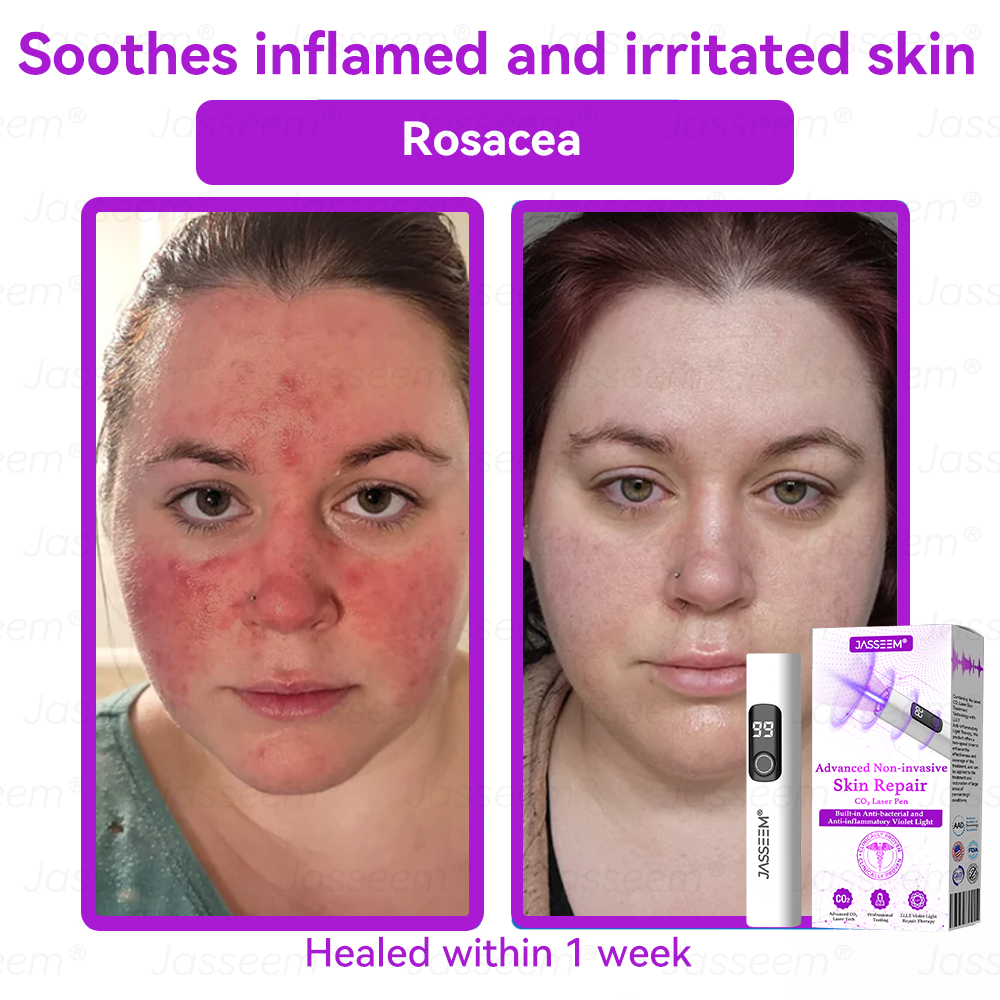 𝐉𝐚𝐬𝐬𝐞𝐞𝐦® 🔥𝐀𝐝𝐯𝐚𝐧𝐜𝐞𝐝 𝐍𝐨𝐧-𝐢𝐧𝐯𝐚𝐬𝐢𝐯𝐞 𝐒𝐤𝐢𝐧 𝐑𝐞𝐩𝐚𝐢𝐫 𝐂𝐎₂ 𝐋𝐚𝐬𝐞𝐫 𝐏𝐞𝐧(Gently gets rid of warts, moles, age spots, and skin tags – no pain, no fuss!)