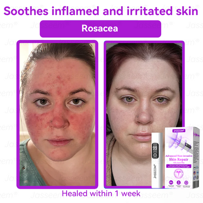 𝐉𝐚𝐬𝐬𝐞𝐞𝐦® 🔥𝐀𝐝𝐯𝐚𝐧𝐜𝐞𝐝 𝐍𝐨𝐧-𝐢𝐧𝐯𝐚𝐬𝐢𝐯𝐞 𝐒𝐤𝐢𝐧 𝐑𝐞𝐩𝐚𝐢𝐫 𝐂𝐎₂ 𝐋𝐚𝐬𝐞𝐫 𝐏𝐞𝐧(Gently gets rid of warts, moles, age spots, and skin tags – no pain, no fuss!)