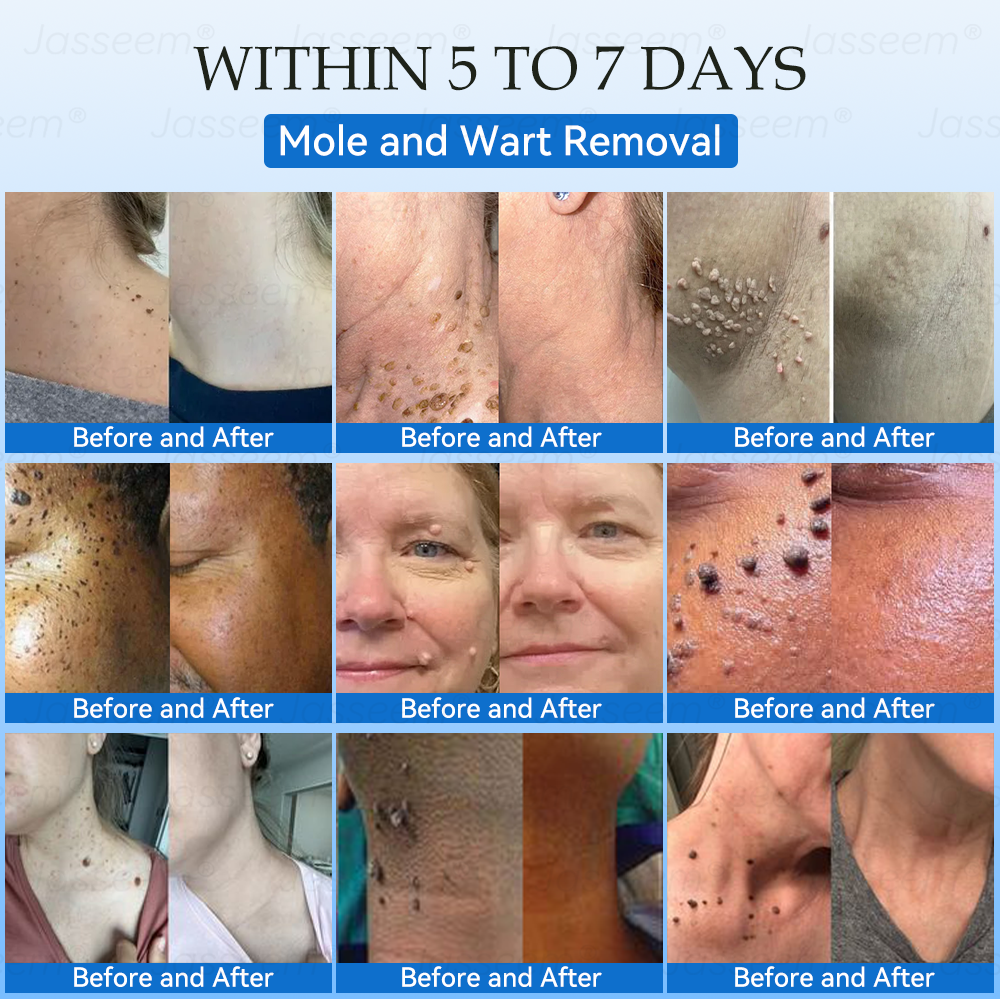 𝐉𝐚𝐬𝐬𝐞𝐞𝐦® ✅✅𝐍𝐨𝐧-𝐈𝐧𝐯𝐚𝐬𝐢𝐯𝐞 𝐌𝐨𝐥𝐞 & 𝐖𝐚𝐫𝐭 𝐋𝐚𝐬𝐞𝐫 𝐑𝐞𝐦𝐨𝐯𝐚𝐥 𝐏𝐞𝐧 (𝐩𝐚𝐢𝐧𝐥𝐞𝐬𝐬 𝐫𝐞𝐦𝐨𝐯𝐚𝐥 𝐨𝐟 𝐰𝐚𝐫𝐭𝐬, 𝐦𝐨𝐥𝐞𝐬, 𝐚𝐠𝐞 𝐬𝐩𝐨𝐭𝐬, 𝐚𝐧𝐝 𝐬𝐤𝐢𝐧 𝐭𝐚𝐠𝐬)