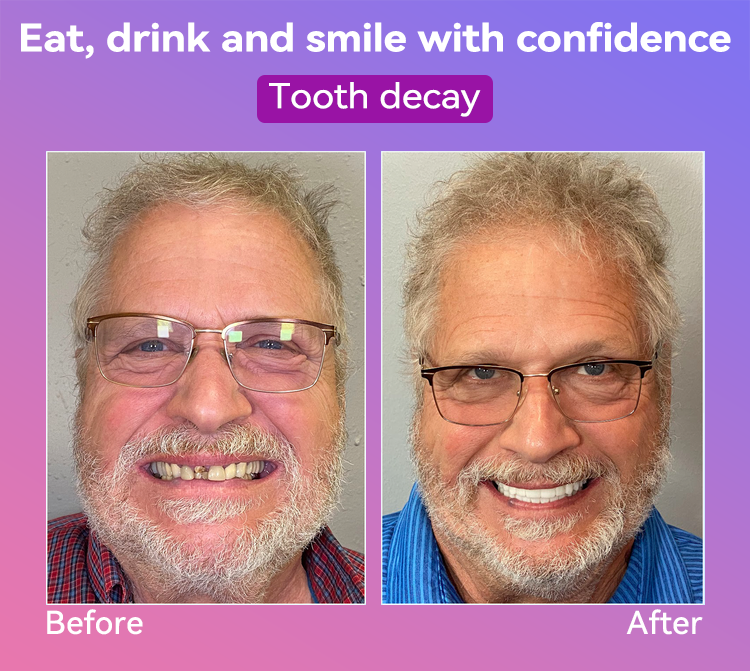 𝐉𝐚𝐬𝐬𝐞𝐞𝐦® Latest Premium Comfort Dentures🎁 (High-End Dentures, Easy to Wear - Limited Time 70% Discount)