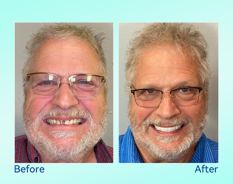 🔥 Only 4 boxes left! Enjoy an extra 50% off! Recommended by dentists, 𝐁𝐢𝐤𝐞𝐧𝐝𝐚® ensures your oral health so you can enjoy meals safely and naturally. Don’t miss out—act now or wait until next year! Enhance your oral health today!