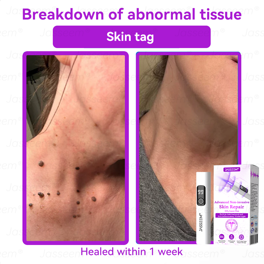 𝐉𝐚𝐬𝐬𝐞𝐞𝐦® 🔥𝐀𝐝𝐯𝐚𝐧𝐜𝐞𝐝 𝐍𝐨𝐧-𝐢𝐧𝐯𝐚𝐬𝐢𝐯𝐞 𝐒𝐤𝐢𝐧 𝐑𝐞𝐩𝐚𝐢𝐫 𝐂𝐎₂ 𝐋𝐚𝐬𝐞𝐫 𝐏𝐞𝐧(Gently gets rid of warts, moles, age spots, and skin tags – no pain, no fuss!)