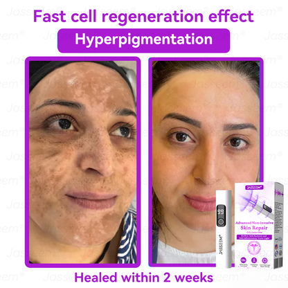𝐉𝐚𝐬𝐬𝐞𝐞𝐦® 🔥𝐀𝐝𝐯𝐚𝐧𝐜𝐞𝐝 𝐍𝐨𝐧-𝐢𝐧𝐯𝐚𝐬𝐢𝐯𝐞 𝐒𝐤𝐢𝐧 𝐑𝐞𝐩𝐚𝐢𝐫 𝐂𝐎₂ 𝐋𝐚𝐬𝐞𝐫 𝐏𝐞𝐧(Gently gets rid of warts, moles, age spots, and skin tags – no pain, no fuss!)