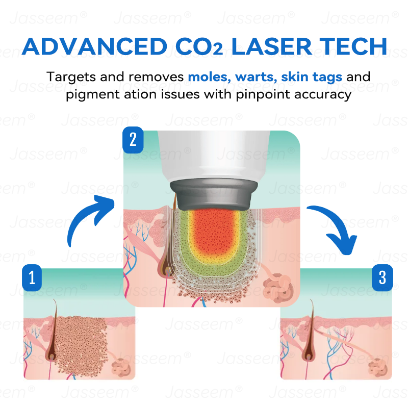 𝐉𝐚𝐬𝐬𝐞𝐞𝐦® ✅✅𝐍𝐨𝐧-𝐈𝐧𝐯𝐚𝐬𝐢𝐯𝐞 𝐌𝐨𝐥𝐞 & 𝐖𝐚𝐫𝐭 𝐋𝐚𝐬𝐞𝐫 𝐑𝐞𝐦𝐨𝐯𝐚𝐥 𝐏𝐞𝐧 (𝐩𝐚𝐢𝐧𝐥𝐞𝐬𝐬 𝐫𝐞𝐦𝐨𝐯𝐚𝐥 𝐨𝐟 𝐰𝐚𝐫𝐭𝐬, 𝐦𝐨𝐥𝐞𝐬, 𝐚𝐠𝐞 𝐬𝐩𝐨𝐭𝐬, 𝐚𝐧𝐝 𝐬𝐤𝐢𝐧 𝐭𝐚𝐠𝐬)