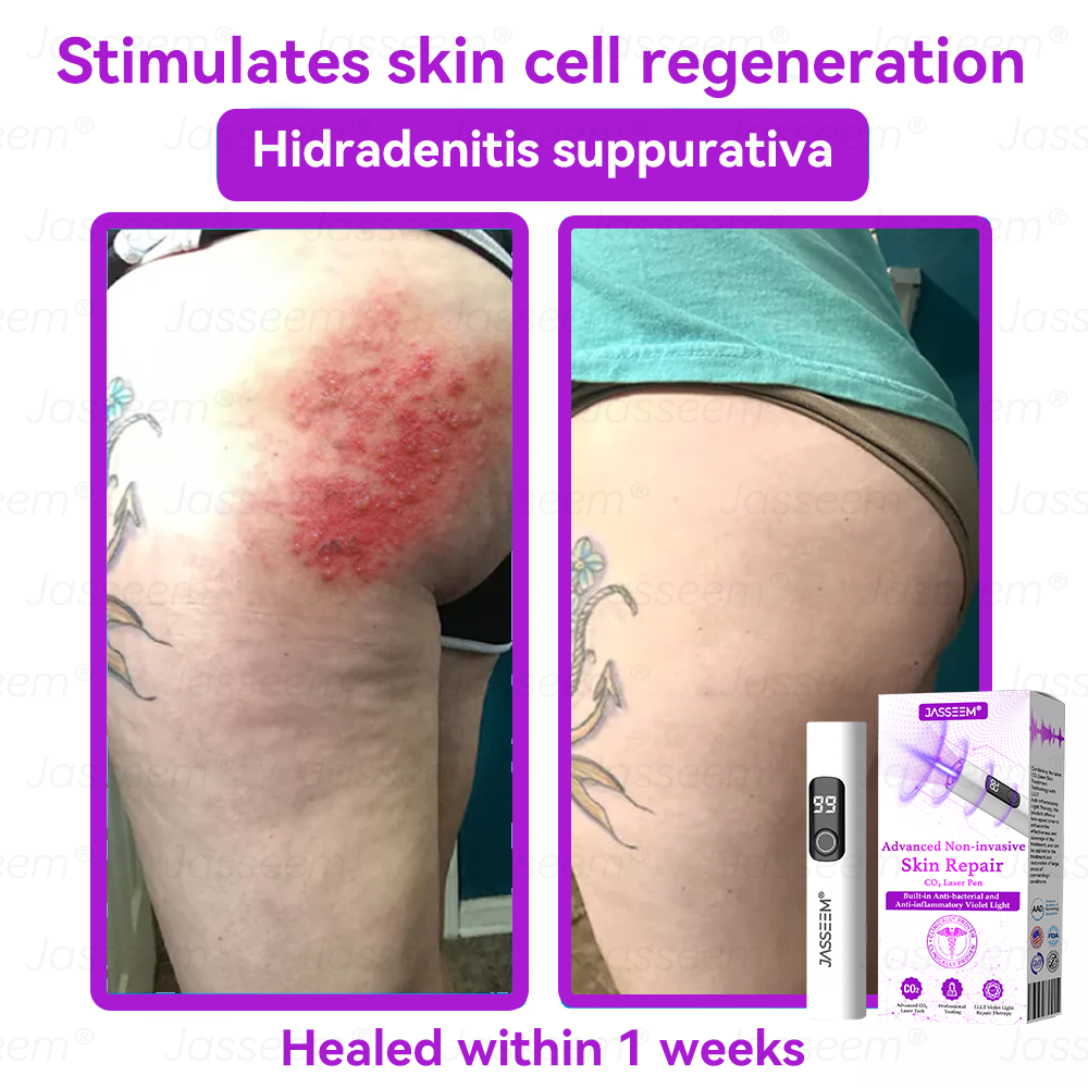 𝐉𝐚𝐬𝐬𝐞𝐞𝐦® 🔥𝐀𝐝𝐯𝐚𝐧𝐜𝐞𝐝 𝐍𝐨𝐧-𝐢𝐧𝐯𝐚𝐬𝐢𝐯𝐞 𝐒𝐤𝐢𝐧 𝐑𝐞𝐩𝐚𝐢𝐫 𝐂𝐎₂ 𝐋𝐚𝐬𝐞𝐫 𝐏𝐞𝐧(Gently gets rid of warts, moles, age spots, and skin tags – no pain, no fuss!)