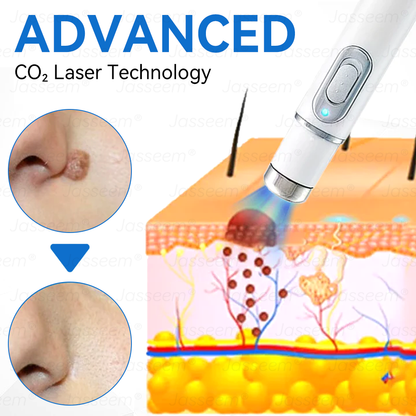 𝐉𝐚𝐬𝐬𝐞𝐞𝐦® ✅✅𝐍𝐨𝐧-𝐈𝐧𝐯𝐚𝐬𝐢𝐯𝐞 𝐌𝐨𝐥𝐞 & 𝐖𝐚𝐫𝐭 𝐋𝐚𝐬𝐞𝐫 𝐑𝐞𝐦𝐨𝐯𝐚𝐥 𝐏𝐞𝐧 (𝐩𝐚𝐢𝐧𝐥𝐞𝐬𝐬 𝐫𝐞𝐦𝐨𝐯𝐚𝐥 𝐨𝐟 𝐰𝐚𝐫𝐭𝐬, 𝐦𝐨𝐥𝐞𝐬, 𝐚𝐠𝐞 𝐬𝐩𝐨𝐭𝐬, 𝐚𝐧𝐝 𝐬𝐤𝐢𝐧 𝐭𝐚𝐠𝐬)