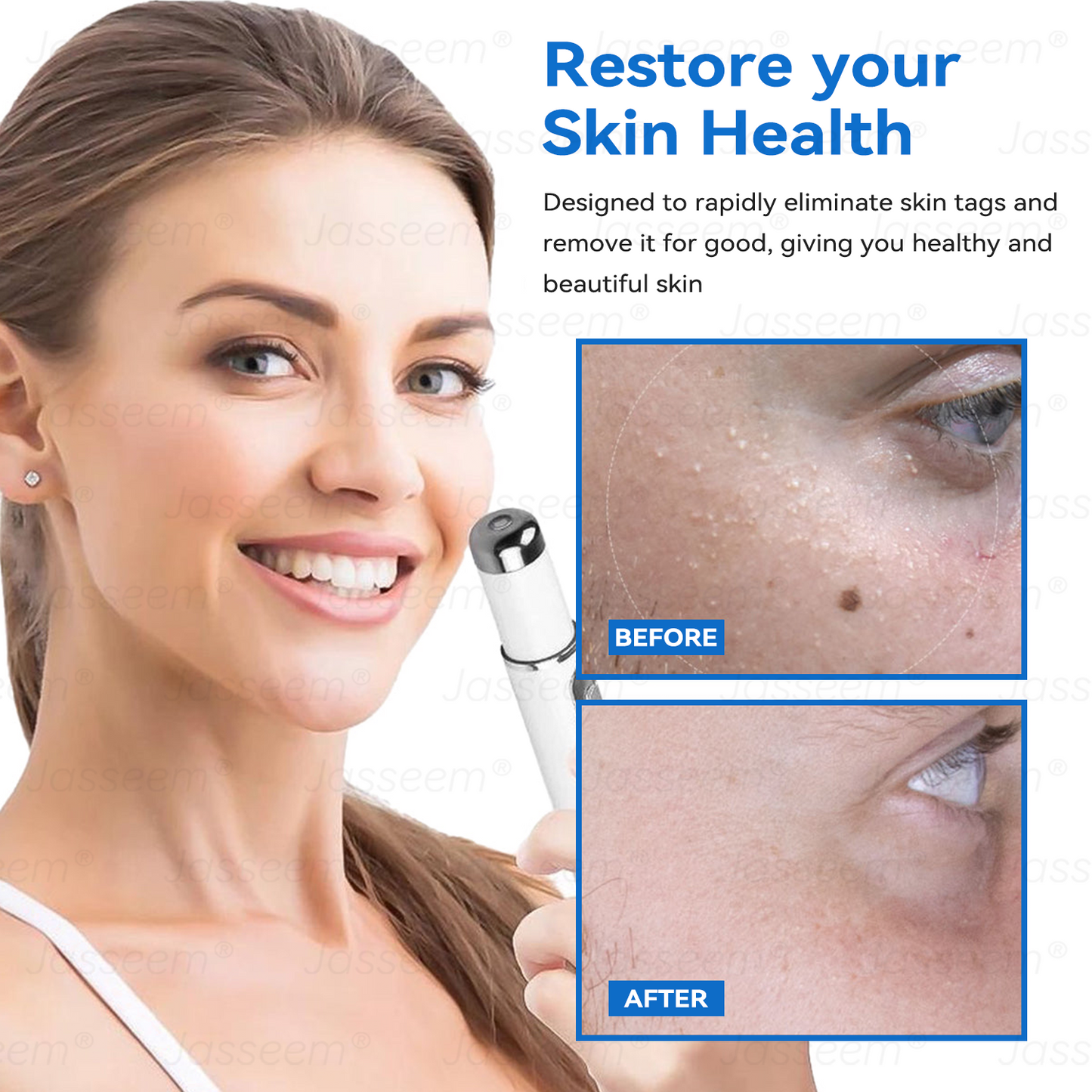 𝐉𝐚𝐬𝐬𝐞𝐞𝐦® ✅✅𝐍𝐨𝐧-𝐈𝐧𝐯𝐚𝐬𝐢𝐯𝐞 𝐌𝐨𝐥𝐞 & 𝐖𝐚𝐫𝐭 𝐋𝐚𝐬𝐞𝐫 𝐑𝐞𝐦𝐨𝐯𝐚𝐥 𝐏𝐞𝐧 (𝐩𝐚𝐢𝐧𝐥𝐞𝐬𝐬 𝐫𝐞𝐦𝐨𝐯𝐚𝐥 𝐨𝐟 𝐰𝐚𝐫𝐭𝐬, 𝐦𝐨𝐥𝐞𝐬, 𝐚𝐠𝐞 𝐬𝐩𝐨𝐭𝐬, 𝐚𝐧𝐝 𝐬𝐤𝐢𝐧 𝐭𝐚𝐠𝐬)