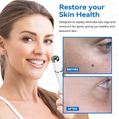 𝐉𝐚𝐬𝐬𝐞𝐞𝐦® ✅✅𝐍𝐨𝐧-𝐈𝐧𝐯𝐚𝐬𝐢𝐯𝐞 𝐌𝐨𝐥𝐞 & 𝐖𝐚𝐫𝐭 𝐋𝐚𝐬𝐞𝐫 𝐑𝐞𝐦𝐨𝐯𝐚𝐥 𝐏𝐞𝐧 (𝐩𝐚𝐢𝐧𝐥𝐞𝐬𝐬 𝐫𝐞𝐦𝐨𝐯𝐚𝐥 𝐨𝐟 𝐰𝐚𝐫𝐭𝐬, 𝐦𝐨𝐥𝐞𝐬, 𝐚𝐠𝐞 𝐬𝐩𝐨𝐭𝐬, 𝐚𝐧𝐝 𝐬𝐤𝐢𝐧 𝐭𝐚𝐠𝐬)