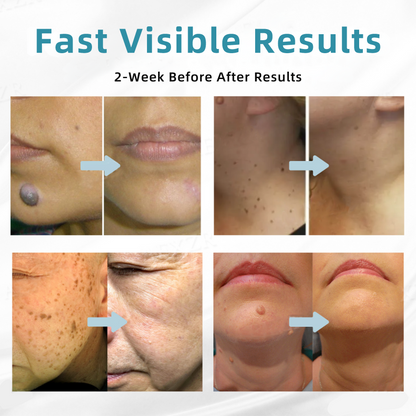 𝐉𝐚𝐬𝐬𝐞𝐞𝐦® Medical-Grade Laser Pen 💕 (Powered by CO₂ laser technology – effectively removes moles, warts, skin tags, pigmentation spots, and other skin imperfections)🏆