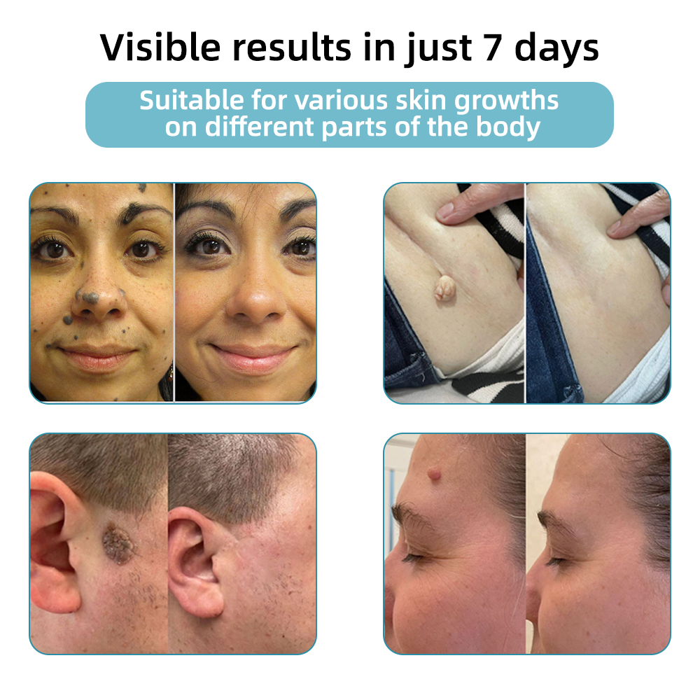 𝐁ik𝐞nd𝐚® ✅✅N𝐨n-inv𝐚siv𝐞 𝐌𝐨l𝐞 and W𝐚rt 𝐑𝐞m𝐨v𝐚l L𝐚s𝐞r 𝐏𝐞n 𝐏r𝐨m𝐚x