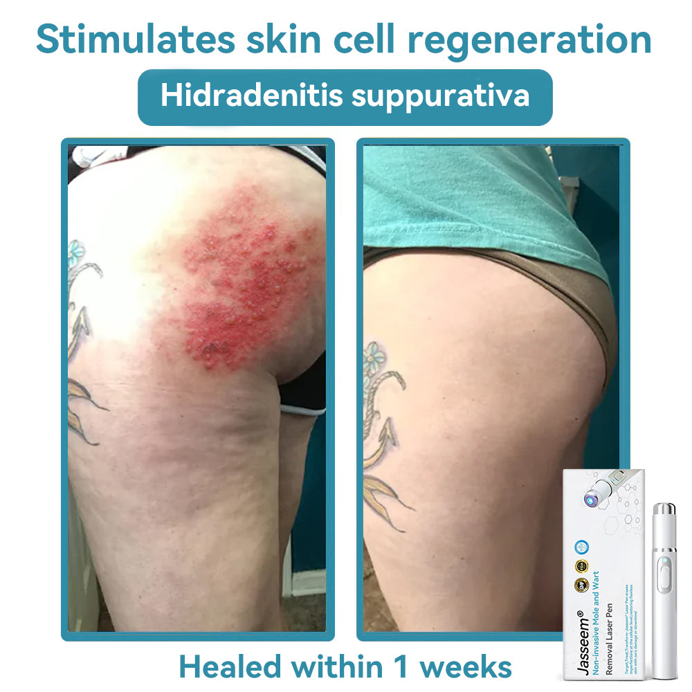 1 Piece – (Non-invasive professional mole and wart removal)