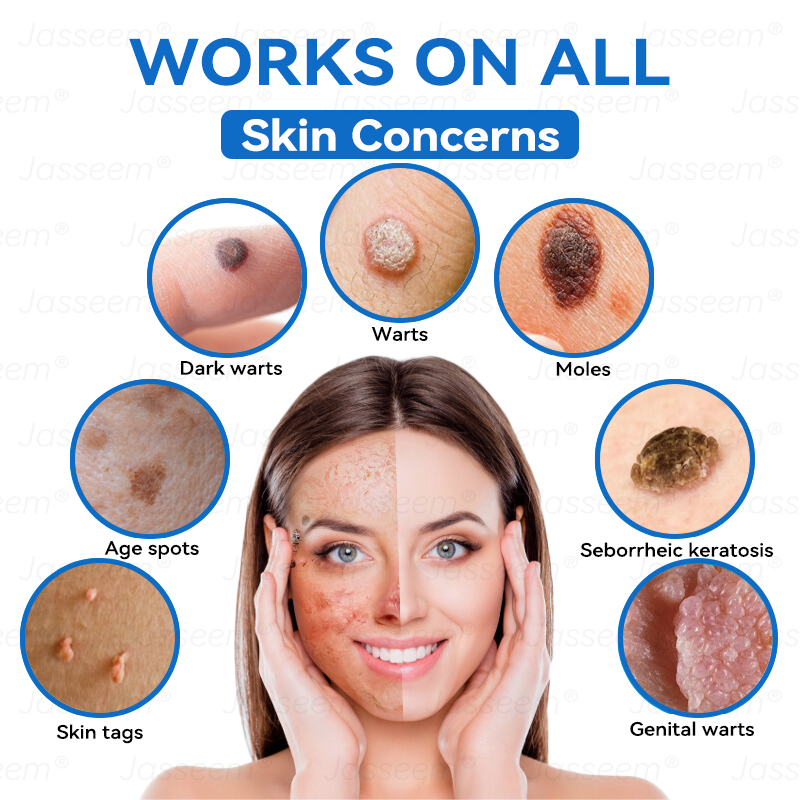 𝐉𝐚𝐬𝐬𝐞𝐞𝐦® ✅✅𝐍𝐨𝐧-𝐈𝐧𝐯𝐚𝐬𝐢𝐯𝐞 𝐌𝐨𝐥𝐞 & 𝐖𝐚𝐫𝐭 𝐋𝐚𝐬𝐞𝐫 𝐑𝐞𝐦𝐨𝐯𝐚𝐥 𝐏𝐞𝐧 (𝐩𝐚𝐢𝐧𝐥𝐞𝐬𝐬 𝐫𝐞𝐦𝐨𝐯𝐚𝐥 𝐨𝐟 𝐰𝐚𝐫𝐭𝐬, 𝐦𝐨𝐥𝐞𝐬, 𝐚𝐠𝐞 𝐬𝐩𝐨𝐭𝐬, 𝐚𝐧𝐝 𝐬𝐤𝐢𝐧 𝐭𝐚𝐠𝐬)