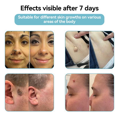 𝐉𝐚𝐬𝐬𝐞𝐞𝐦® Medical-Grade Laser Pen 💕 (Powered by CO₂ laser technology – effectively removes moles, warts, skin tags, pigmentation spots, and other skin imperfections)🏆