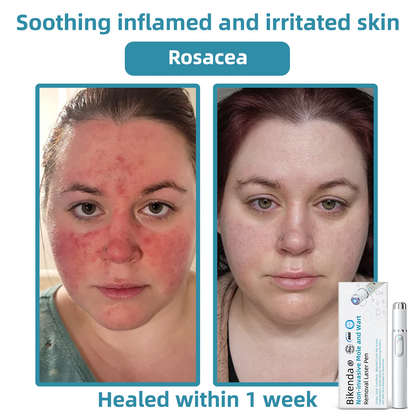 𝐁ik𝐞nd𝐚® ✅✅N𝐨n-inv𝐚siv𝐞 𝐌𝐨l𝐞 and W𝐚rt 𝐑𝐞m𝐨v𝐚l L𝐚s𝐞r 𝐏𝐞n 𝐏r𝐨m𝐚x