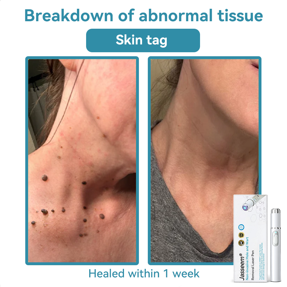 𝐉𝐚𝐬𝐬𝐞𝐞𝐦® Medical-Grade Laser Pen 💕 (Powered by CO₂ laser technology – effectively removes moles, warts, skin tags, pigmentation spots, and other skin imperfections)🏆