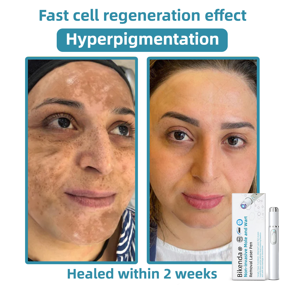 𝐁ik𝐞nd𝐚® ✅✅N𝐨n-inv𝐚siv𝐞 𝐌𝐨l𝐞 and W𝐚rt 𝐑𝐞m𝐨v𝐚l L𝐚s𝐞r 𝐏𝐞n 𝐏r𝐨m𝐚x