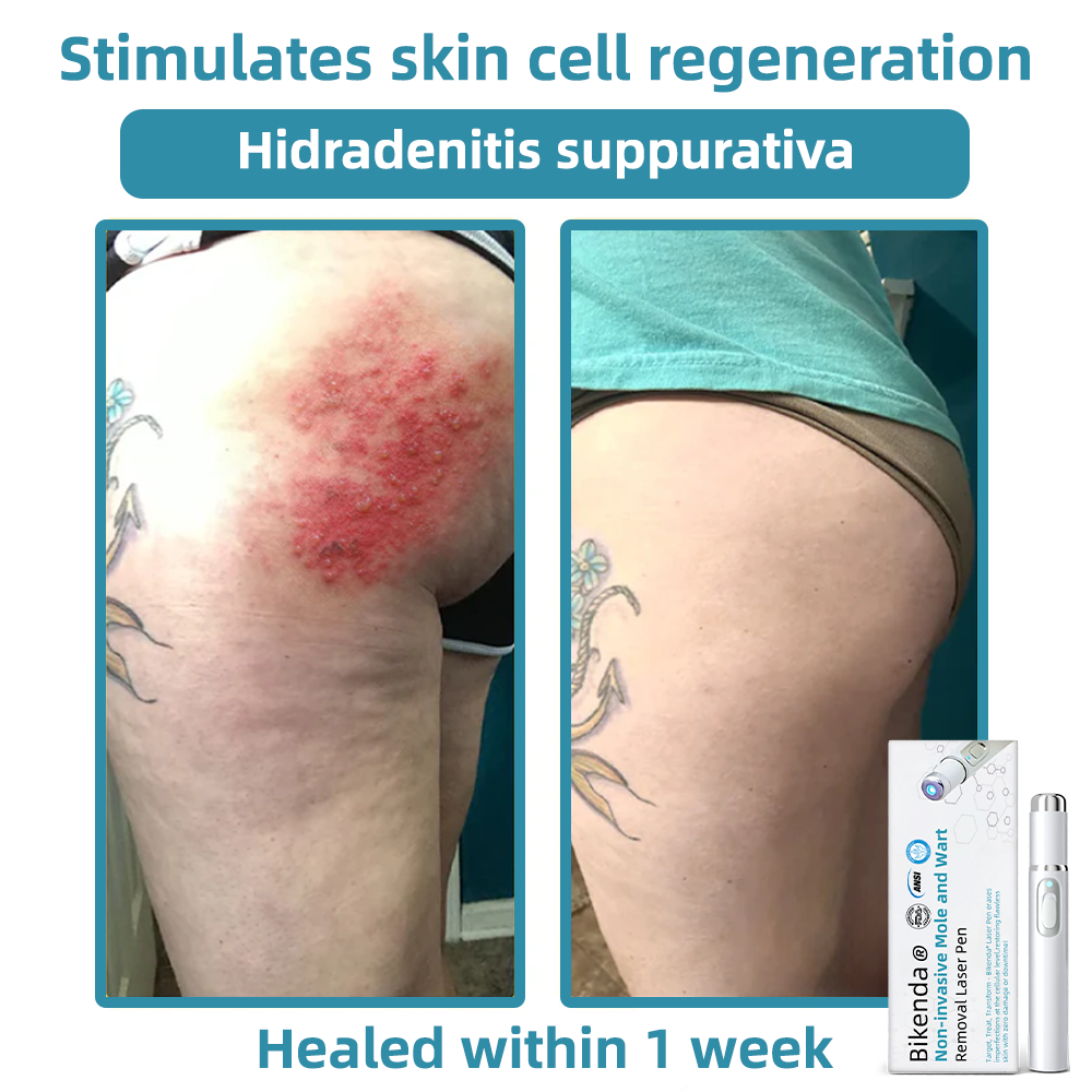 𝐁ik𝐞nd𝐚® ✅✅N𝐨n-inv𝐚siv𝐞 𝐌𝐨l𝐞 and W𝐚rt 𝐑𝐞m𝐨v𝐚l L𝐚s𝐞r 𝐏𝐞n 𝐏r𝐨m𝐚x